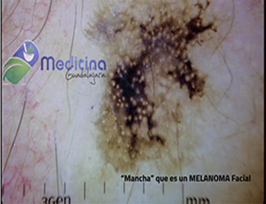 Especialista en Tratamiento de Lunares malignos de piel en Guadalajara Jalisco Mexico, Biopsia de lunares