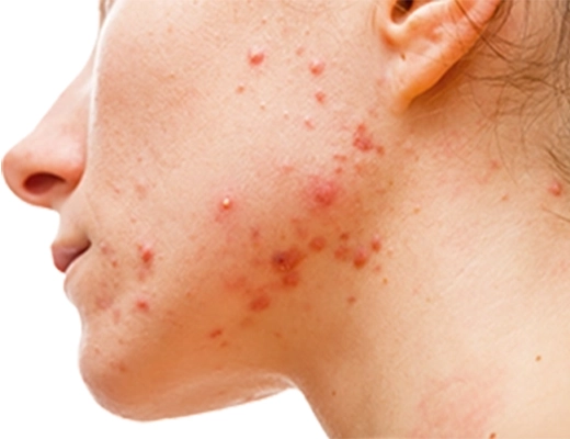 Especialista en Tratamiento de barros y espinillas en Guadalajara Jalisco Mexico , Especialista en Acné