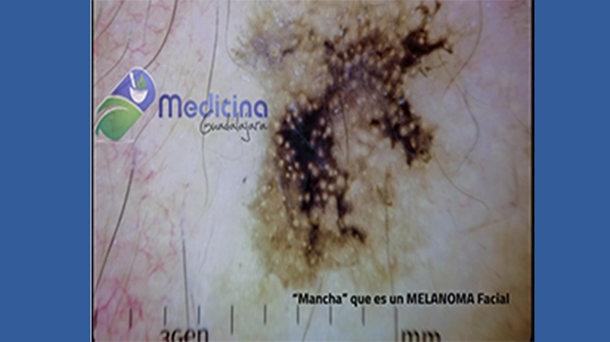 Guía completa sobre lunares y melanoma: información esencial para la detección temprana y el tratamiento