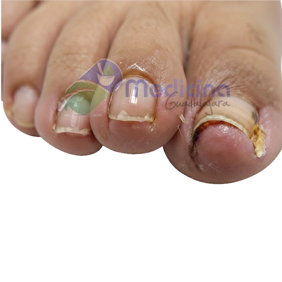 Dermatologo Especialista en cirugía de uñas enterradas en Guadalajara Jalisco Mexico
