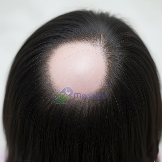 Dermatologo Especialista en tratamiento para la caída del cabello en Guadalajara Jalisco México cáncer