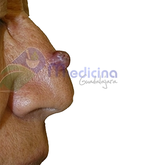 Dermatologo Especialista en tratamiento para el cáncer basocelular en la cara con cirugía dermatológica Guadalajara Jalisco