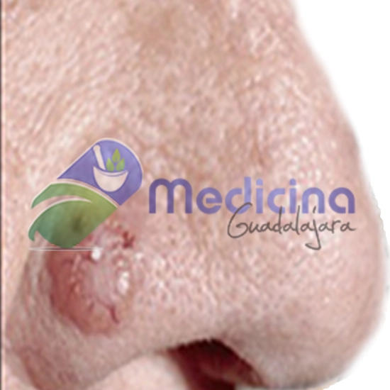 Dermatologo Especialista en tratamiento  para el cáncer espinocelular en la cara con cirugía dermatológica Guadalajara Jalisco