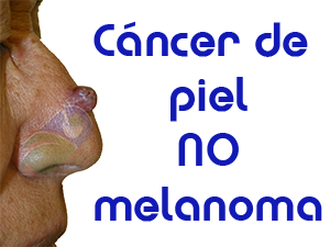 cancer de piel no melonoma Dr Guillermo Valdes Gonzalez Dermatologia Guadalajara Jalisco Mexico