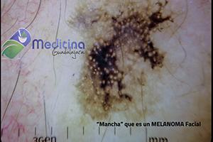 lunar maligno melanoma Dr Guillermo Valdes Gonzalez Medicina Guadalajara Jalisco Mexico