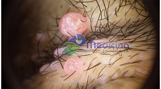 Moluscos contagiosos Dr Guillermo Valdes Gonzalez Medicina Guadalajara Jalisco Mexico