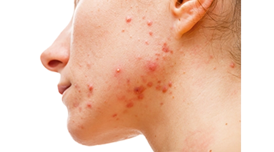 acne guadalajara jalisco mexico