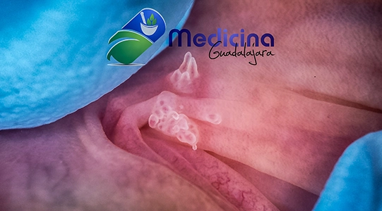 Especialista en papiloma genital guadalajara jalisco Mexico